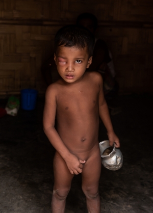 Rohingya One eye child  